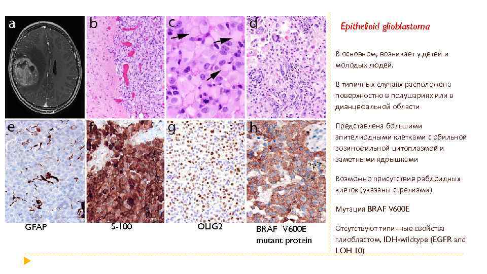 Epithelioid glioblastoma В основном, возникает у детей и молодых людей. В типичных случаях расположена