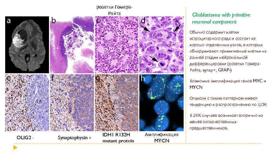 розетки Гомера. Райта Glioblastoma with primitive neuronal component Обычно содержит клетки астроцитарного ряда и