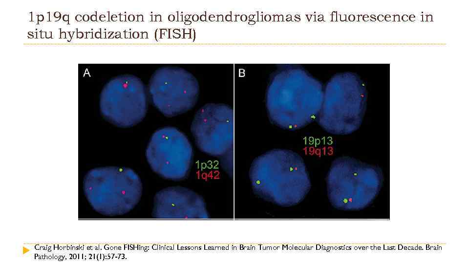 1 p 19 q codeletion in oligodendrogliomas via fluorescence in situ hybridization (FISH) Craig