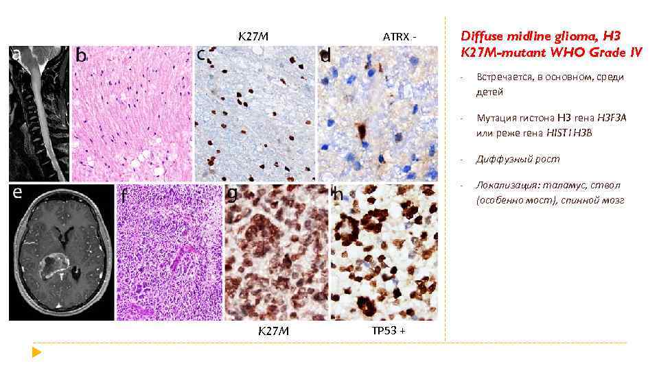 K 27 M ATRX - Diffuse midline glioma, H 3 K 27 M-mutant WHO