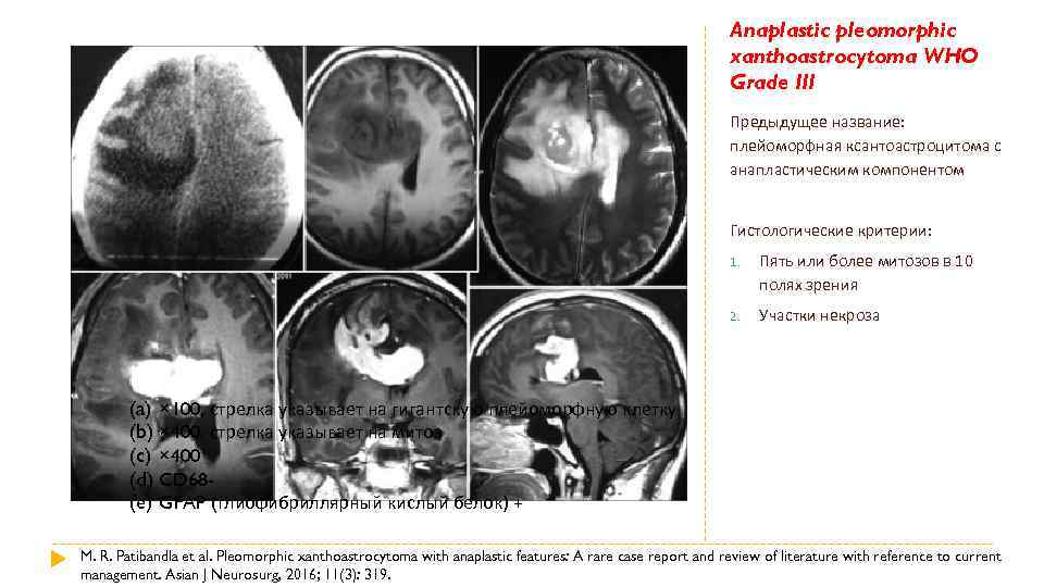 Who grade 3. Классификация опухолей по Grade. Плеоморфная ксантоастроцитома. Классификация опухолей по who – Grade.