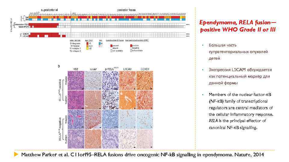 Ependymoma, RELA fusion— positive WHO Grade II or III • Большая часть супратенториальных опухолей