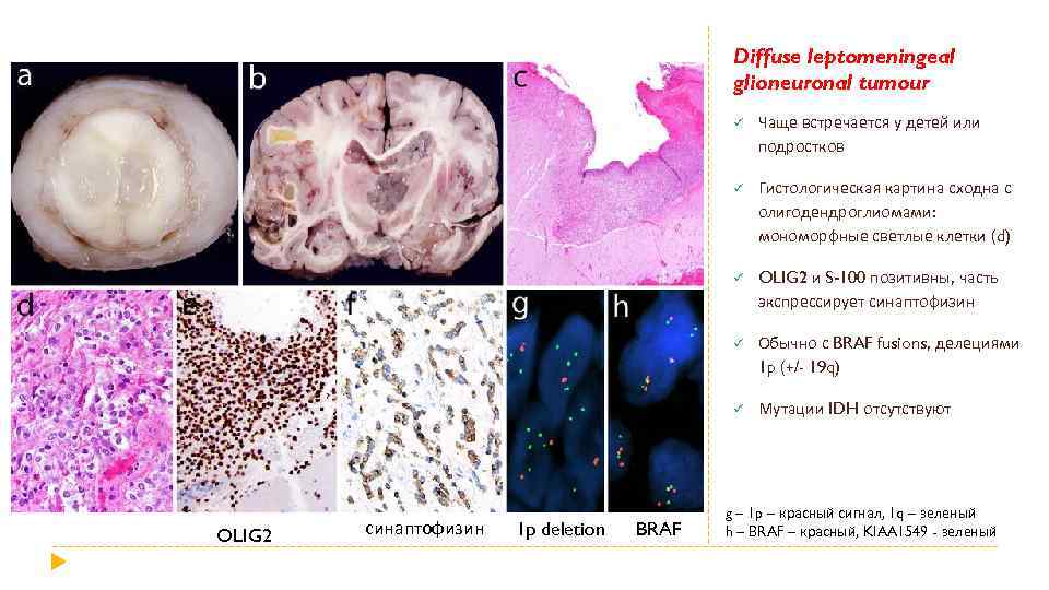 Diffuse leptomeningeal glioneuronal tumour ü ü BRAF Обычно с BRAF fusions, делециями 1 p