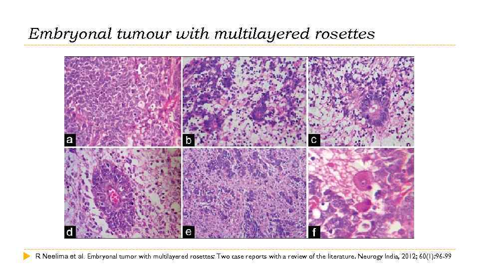 Embryonal tumour with multilayered rosettes R Neelima et al. Embryonal tumor with multilayered rosettes: