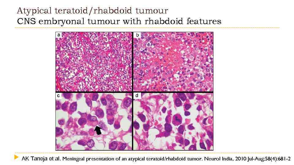 Atypical teratoid/rhabdoid tumour CNS embryonal tumour with rhabdoid features AK Taneja et al. Meningeal