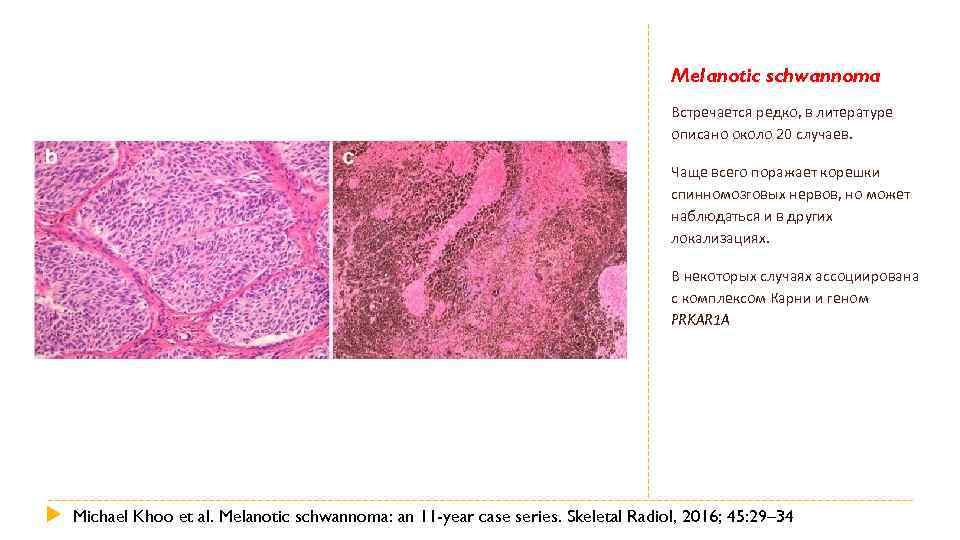 Melanotic schwannoma Встречается редко, в литературе описано около 20 случаев. Чаще всего поражает корешки