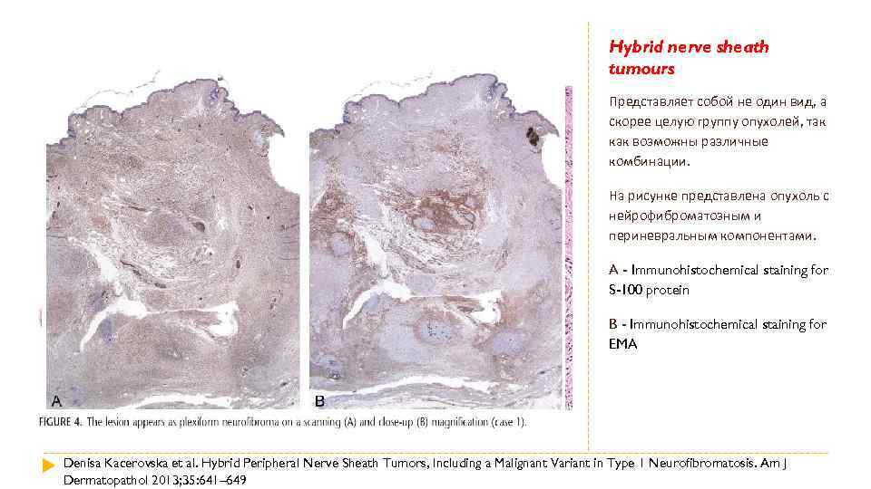 Hybrid nerve sheath tumours Представляет собой не один вид, а скорее целую группу опухолей,