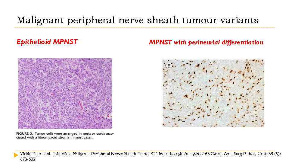 Malignant peripheral nerve sheath tumour variants Epithelioid MPNST with perineurial differentiation Vickie Y. Jo