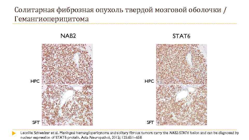 Солитарная фиброзная опухоль твердой мозговой оболочки / Гемангиоперицитома NAB 2 STAT 6 HPC SFT