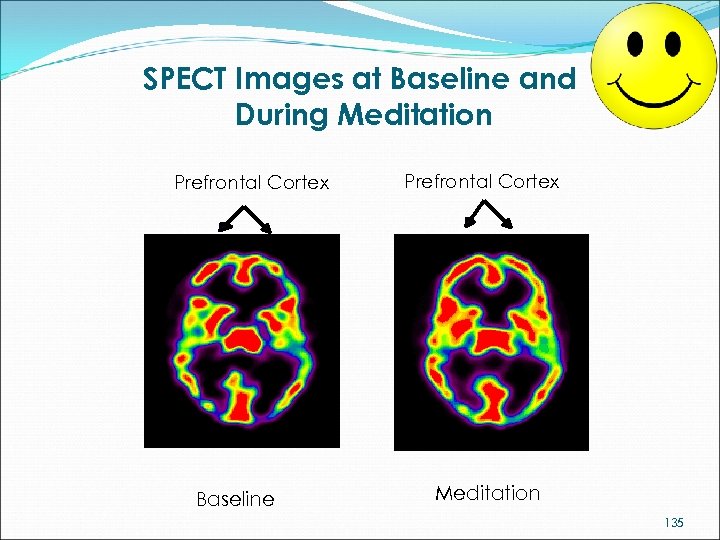 SPECT Images at Baseline and During Meditation Prefrontal Cortex Baseline Prefrontal Cortex Meditation 135