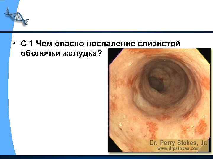  • С 1 Чем опасно воспаление слизистой оболочки желудка? 