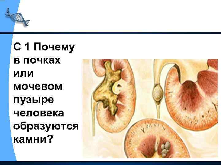 С 1 Почему в почках или мочевом пузыре человека образуются камни? 