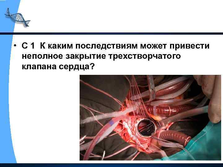  • С 1 К каким последствиям может привести неполное закрытие трехстворчатого клапана сердца?