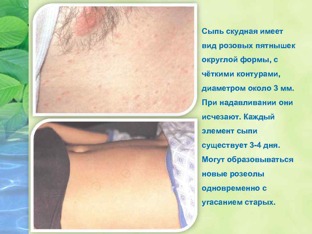 Сыпь скудная имеет вид розовых пятнышек округлой формы, с чёткими контурами, диаметром около 3