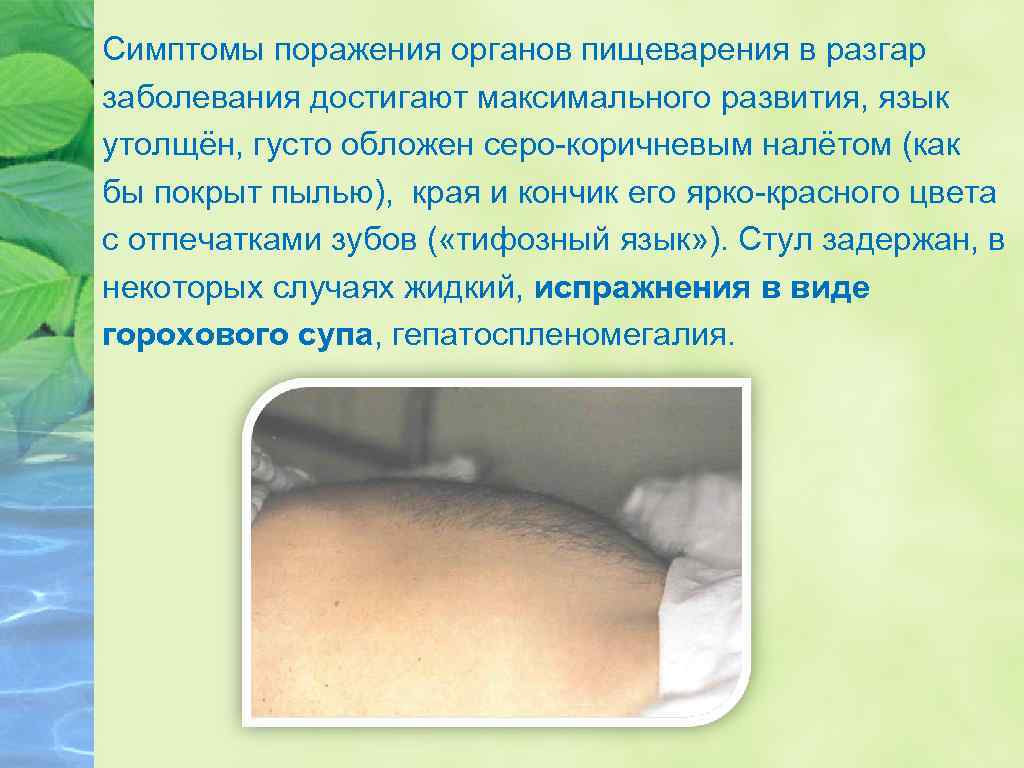 Симптомы поражения органов пищеварения в разгар заболевания достигают максимального развития, язык утолщён, густо обложен