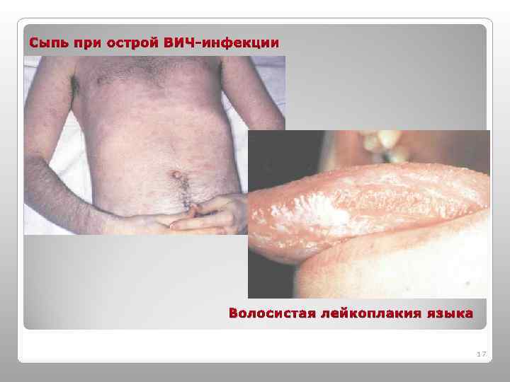 Сыпь при острой ВИЧ-инфекции Волосистая лейкоплакия языка 17 