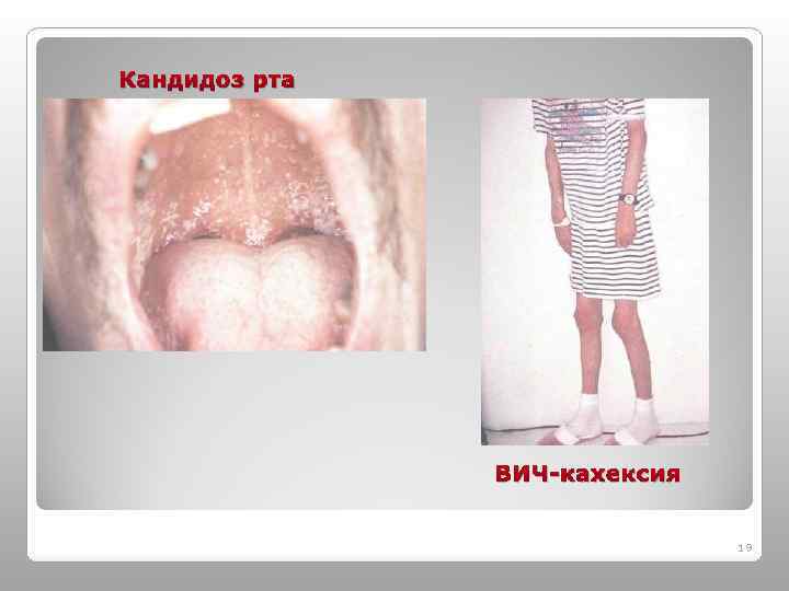 Кандидоз рта ВИЧ-кахексия 19 