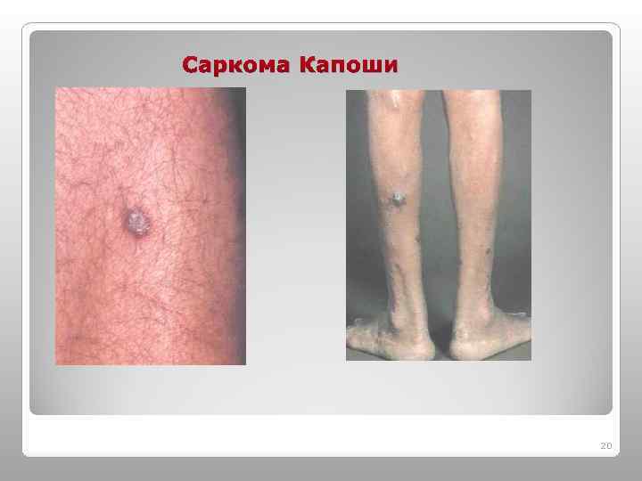 Саркома Капоши 20 
