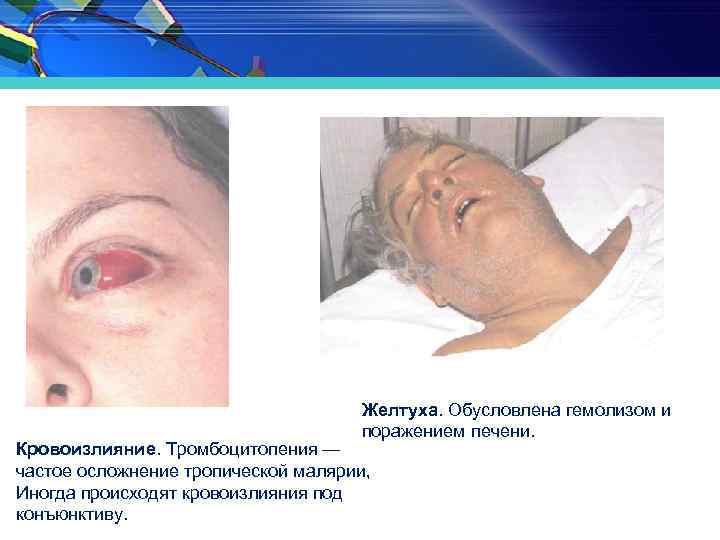 Желтуха. Обусловлена гемолизом и поражением печени. Кровоизлияние. Тромбоцитопения — частое осложнение тропической малярии, Иногда