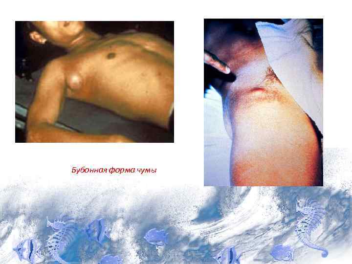 Бубонная форма чумы 