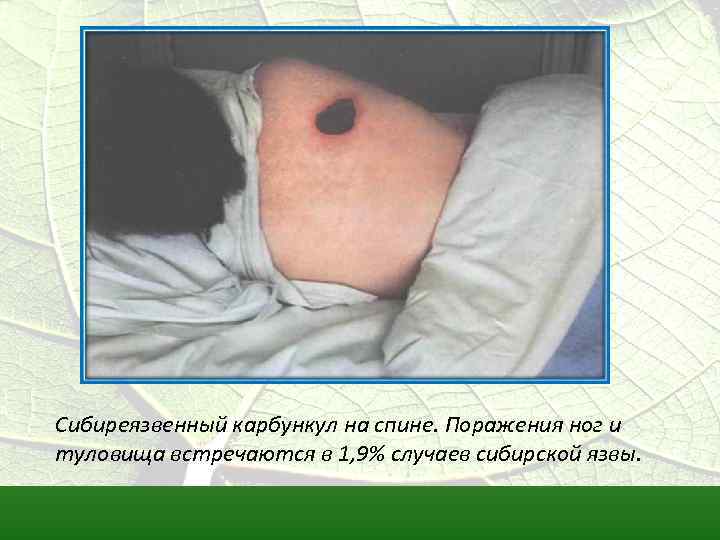 Сибиреязвенный карбункул на спине. Поражения ног и туловища встречаются в 1, 9% случаев сибирской