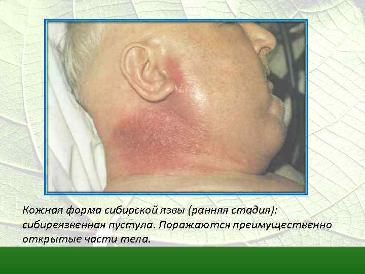Кожная форма сибирской язвы (ранняя стадия): сибиреязвенная пустула. Поражаются преимущественно открытые части тела. 