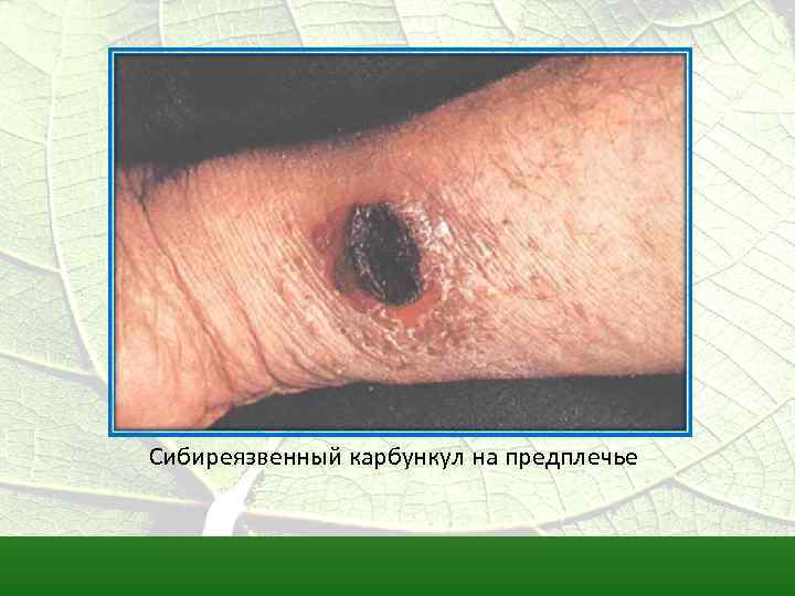 Сибиреязвенный карбункул на предплечье 