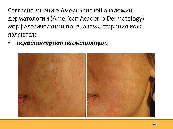 Согласно мнению Американской академии дерматологии (American Acaderro Dermatology) морфологическими признаками старения кожи являются: •