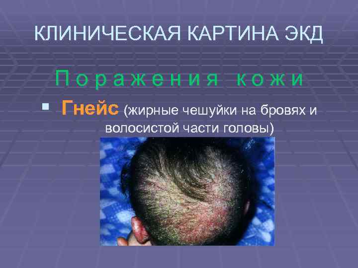 КЛИНИЧЕСКАЯ КАРТИНА ЭКД Поражения кожи § Гнейс (жирные чешуйки на бровях и волосистой части