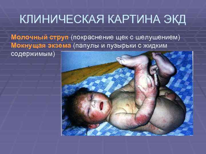 КЛИНИЧЕСКАЯ КАРТИНА ЭКД Молочный струп (покраснение щек с шелушением) Мокнущая экзема (папулы и пузырьки