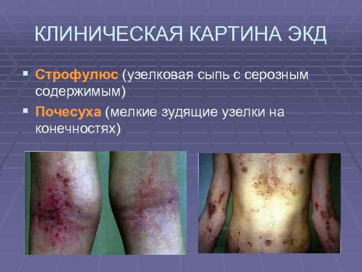 КЛИНИЧЕСКАЯ КАРТИНА ЭКД § Строфулюс (узелковая сыпь с серозным содержимым) § Почесуха (мелкие зудящие