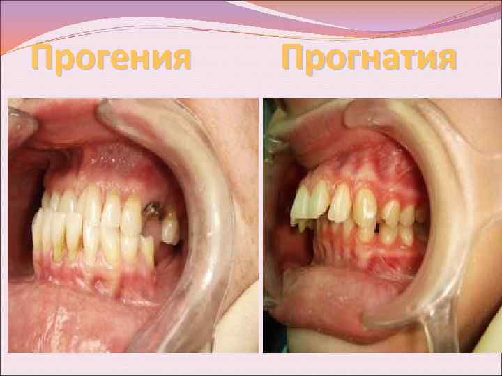 Прогения Прогнатия 