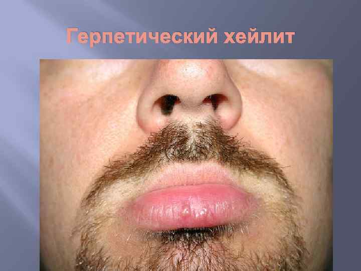 Герпетический хейлит 