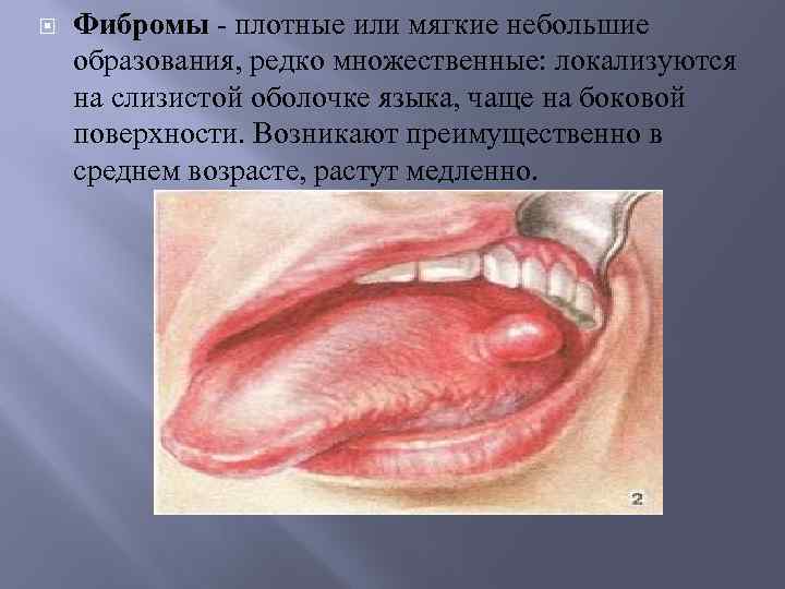  Фибромы - плотные или мягкие небольшие образования, редко множественные: локализуются на слизистой оболочке
