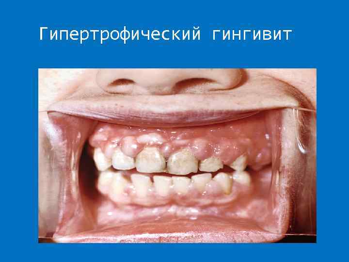 Гипертрофический гингивит 