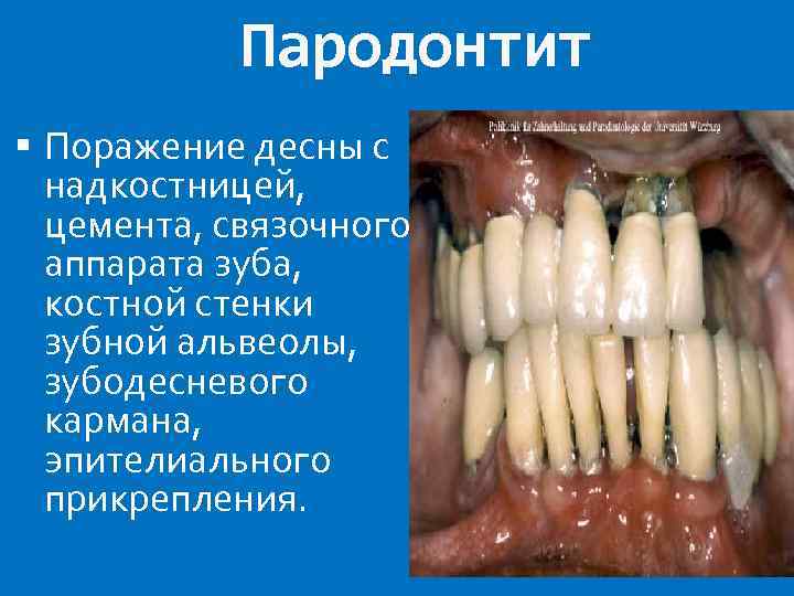 Пародонтит Поражение десны с надкостницей, цемента, связочного аппарата зуба, костной стенки зубной альвеолы, зубодесневого