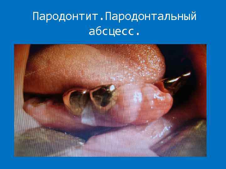 Пародонтит. Пародонтальный абсцесс. 