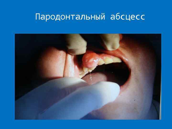 Пародонтальный абсцесс 