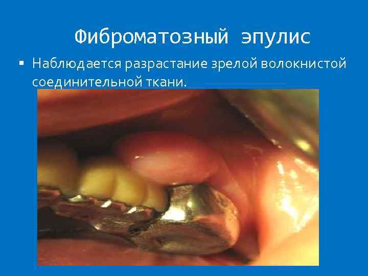Фиброматозный эпулис Наблюдается разрастание зрелой волокнистой соединительной ткани. 