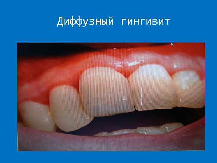 Диффузный гингивит 