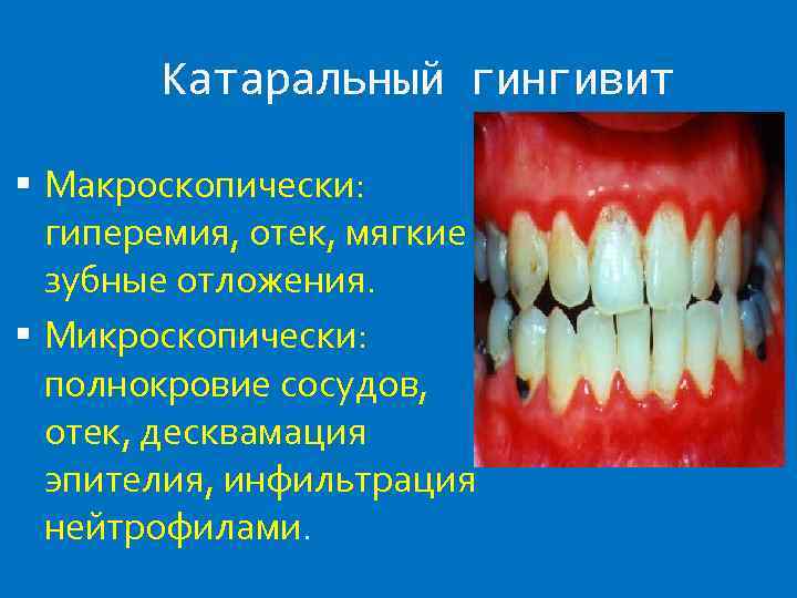 Катаральный гингивит Макроскопически: гиперемия, отек, мягкие зубные отложения. Микроскопически: полнокровие сосудов, отек, десквамация эпителия,