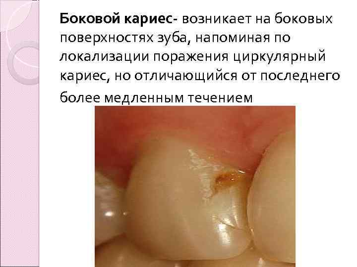 Боковой кариес- возникает на боковых поверхностях зуба, напоминая по локализации поражения циркулярный кариес, но