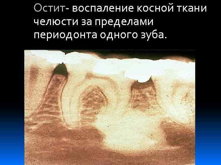 Остит- воспаление косной ткани челюсти за пределами периодонта одного зуба. 