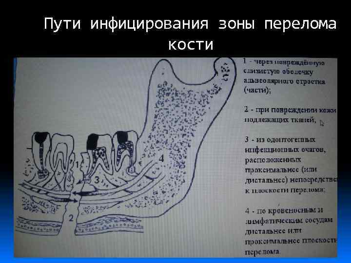Пути инфицирования зоны перелома кости 