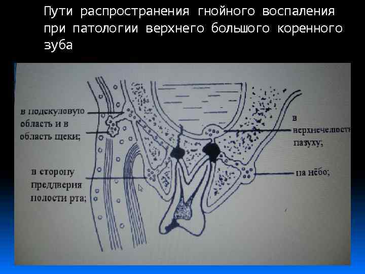 Пути распространения гнойного воспаления при патологии верхнего большого коренного зуба 