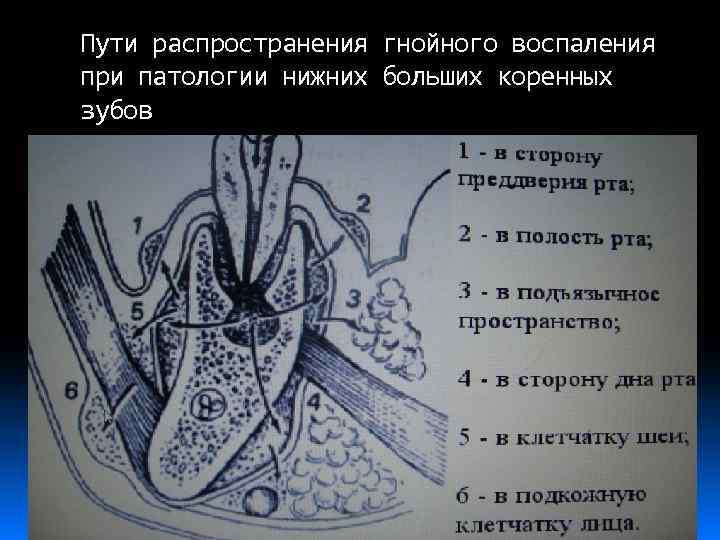 Пути распространения гнойного воспаления при патологии нижних больших коренных зубов 
