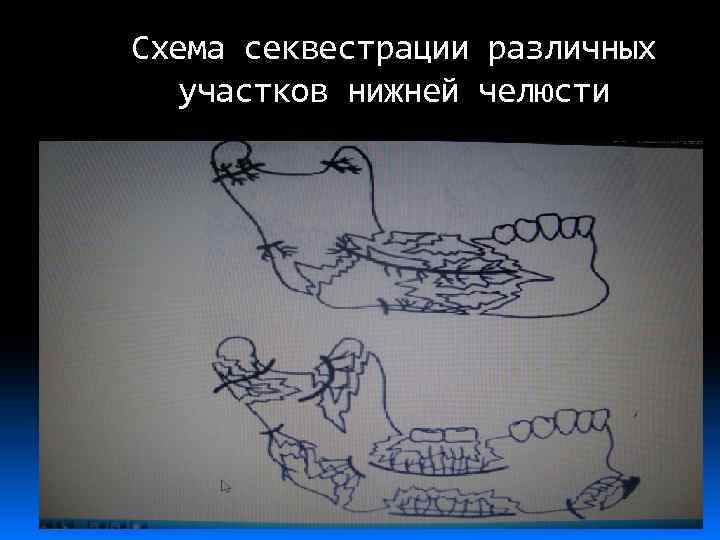 Схема секвестрации различных участков нижней челюсти 