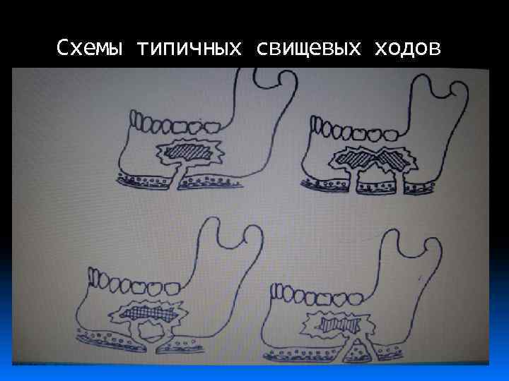 Схемы типичных свищевых ходов 