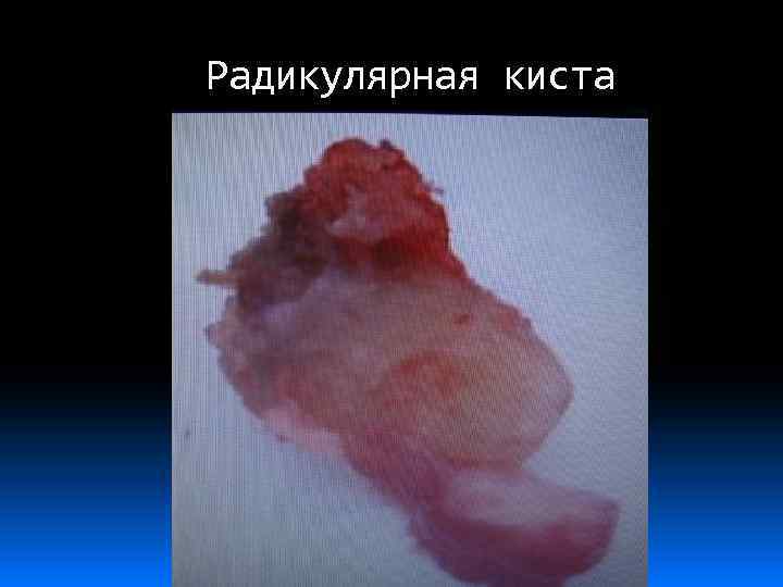 Радикулярная киста 
