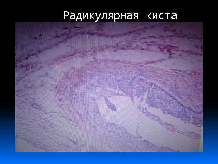 Радикулярная киста 